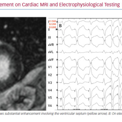 Late Gadolinium Enhancement on Cardiac MRI