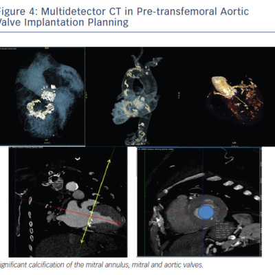 Figure 4 Multidetector CT in Pre-transfemoral Aortic Valve Implantation Planning