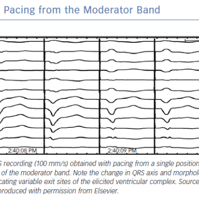 Pacing from the Moderator Band