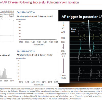 Recurrence of AF 13 Years Following Successful Pulmonary Vein Isolation