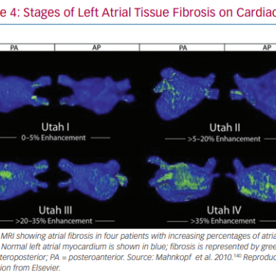 Stages of Left Atrial Tissue Fibrosis on Cardiac MRI