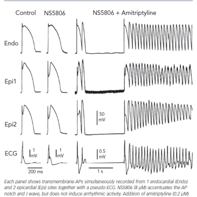 Amitriptyline 0.2 UM Included Brugada Phenotype