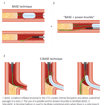 Balloon-assisted Subintimal Entry