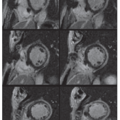 Cardiac MRI Short-Axis Views Demonstrating