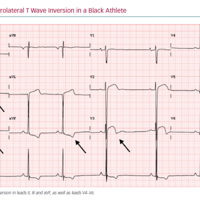 ECG Showing Inferolateral T Wave Inversion in a Black Athlete