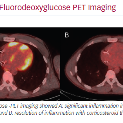 18F-Fluorodeoxyglucose PET Imaging