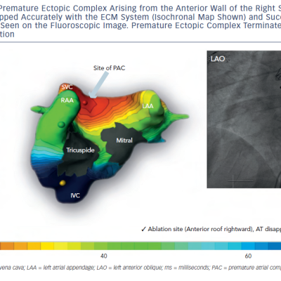 Figure 5 Focal Source Premature Ectopic Complex Arising from the Anterior Wall of the Right Superior PulmonaryVenous Ostium was Mapped Accurately with the ECM System Isochronal Map Shown and Successfully Ablated atthe Corresponding Site Seen on the Fluoroscopic Image. Premature Ectopic Complex Terminated After 9 Seconds ofRadiofrequency Application