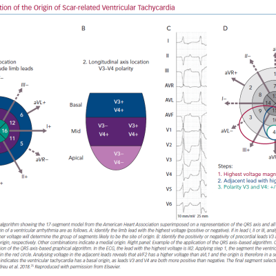 Localisation of the Origin of Scar-related Ventricular Tachycardia