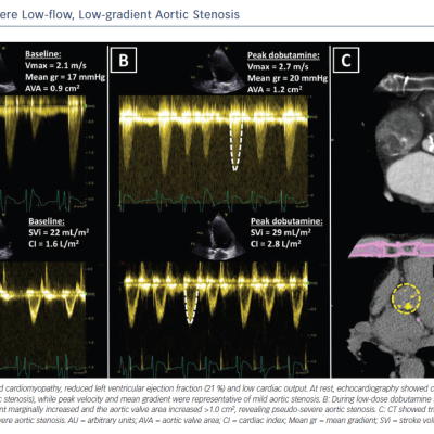 Figure 5 Pseudo-severe Low-flow Low-gradient Aortic Stenosis