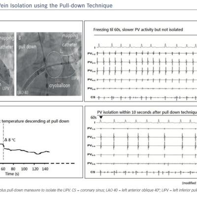 Figure 5 Pulmonary Vein Isolation using the Pull-down Technique