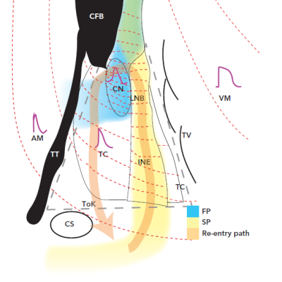 Figure 5 Schematic of the AVN FP and SP