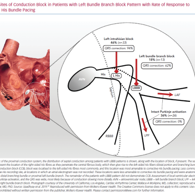 Sites of Conduction Block in Patients