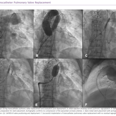 Transcatheter Pulmonary Valve Replacement