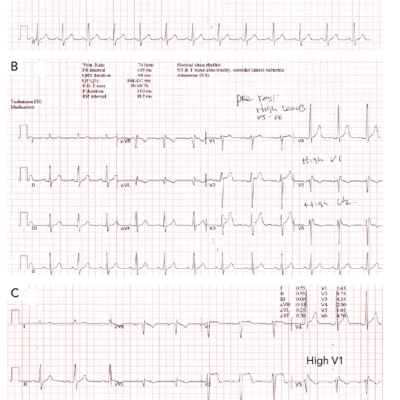 Figure 6 Ajmaline Challenge Testing