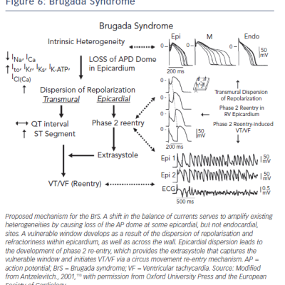 Brugada Sybdrome