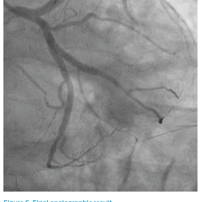 Figure 6. Final angiographic result