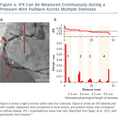 Figure 6 IFR Can Be Measured Continuously During A Pressure Wire Pullback Across Multiple Stenoses