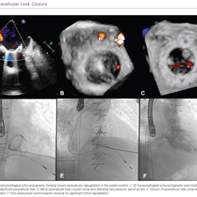 Paravalvular Leak Closure