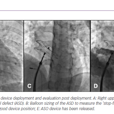 Atrial Septal Defect Closure