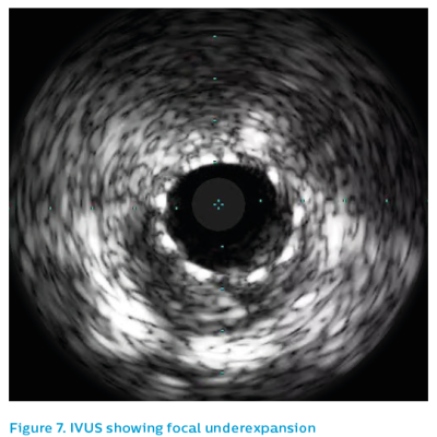 Figure 7. IVUS showing focal underexpansion