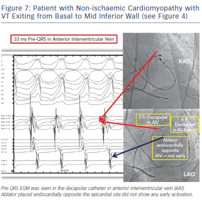 Patient with Non-ischaemic Cardiomyopathy