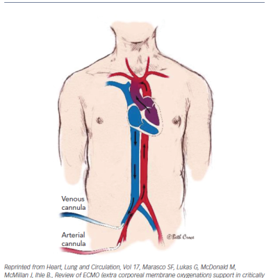 Figure 7 Peripheral Extracorporal Membrane Oxygenation Cannulation