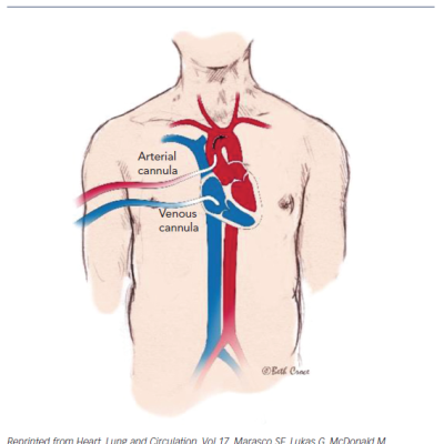 Figure 8 Central Extracorporal Membrane Oxygenation Cannulation