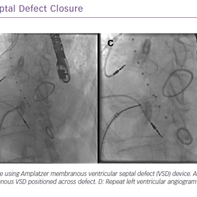 Membranous Ventricular Septal Defect Closure