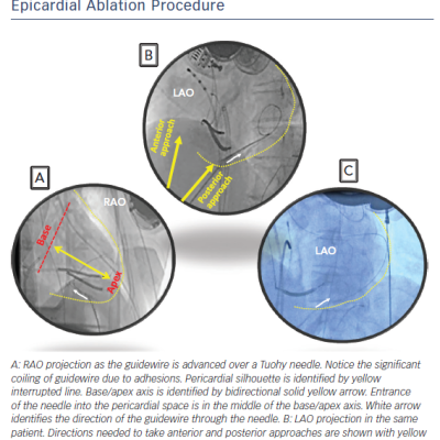 Anterior &ampamp Posterior Approach