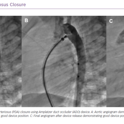 Patent Ductus Arteriosus Closure