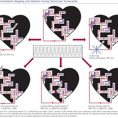 Entrainment Mapping and Ablation During Ventricular Tachycardia