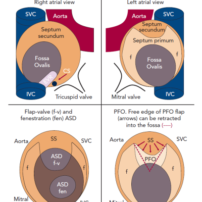 Diagrammatic Representations of the Interatrial Septum and its Anatomical Relations