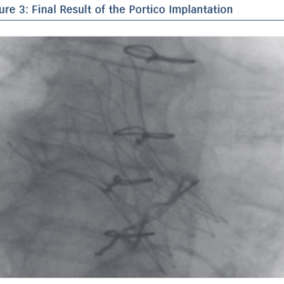 Figure 3 Final Result of the Portico Implantation