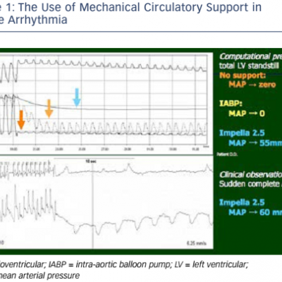 The Use of Mechanical Circulatory Support in Severe Arrhythmia