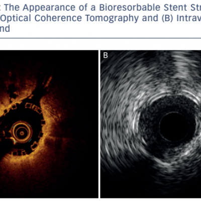 The Appearance of a Bioresorbable Stent Strut with A Optical Coherence Tomography and B Intravascular Ultrasound