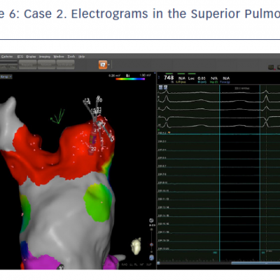 figure 6-case-2-electrograms-in-the-superior