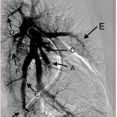 Multiple Lesion Types on Pulmonary Angiogram