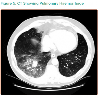 CT Showing Pulmonary Haemorrhage