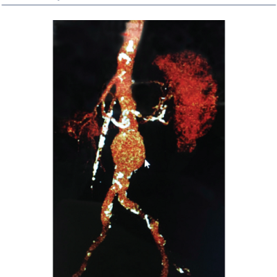 Figure 1 Computed Tomography Angiography Reconstruction of a 5.7-cm long Infrarenal Abdominal Aortic Aneurysm