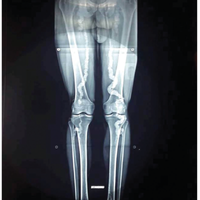 Extensive Diffuse Calcification