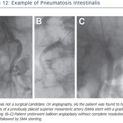 Figure 12 Example of Pneumatosis Intestinalis