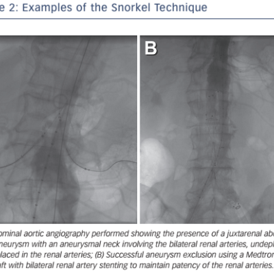 Figure 2 Examples of the Snorkel Technique