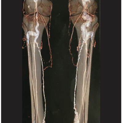 Follow-Up CT Angiography