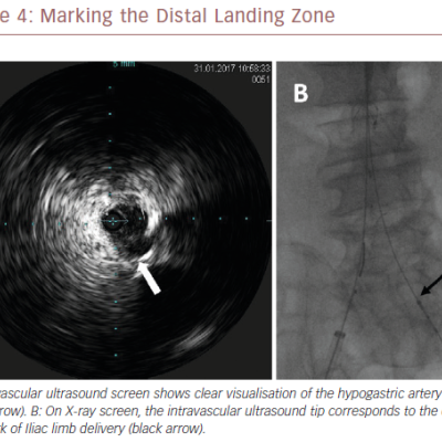 Marking The Distal Landing Zone