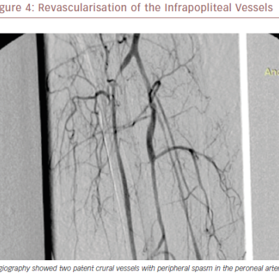 Revascularisation Of The Infrapopliteal Vessels