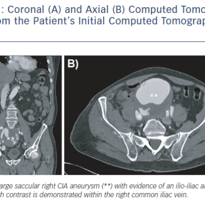 Coronal A and Axial B Computed Tomography Slice from the Patient’s Initial Computed Tomography Scan