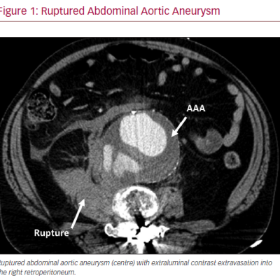 Ruptured Abdominal Aortic Aneurysm