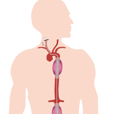 Transcarotid Thoracic Endovascular Aortic Repair and Endovascular Aortic Repair