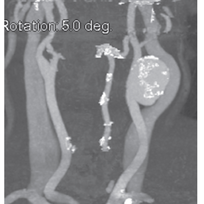 CT Angiography Performed to Confirm the Presence