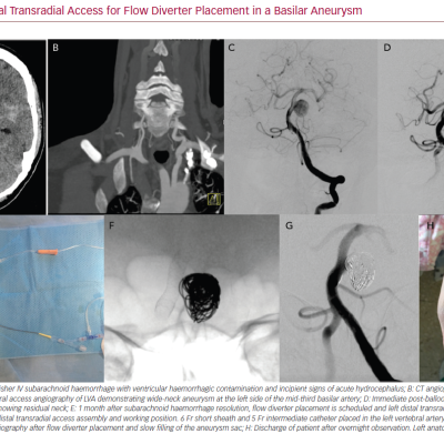 Left Distal Transradial Access for Flow Diverter Placement